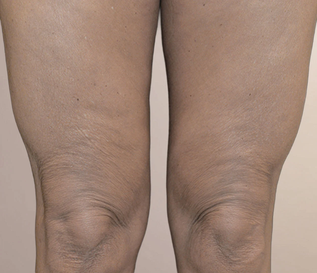 Ezen a képen gyógyult szájtetoválásról vannak fotók.