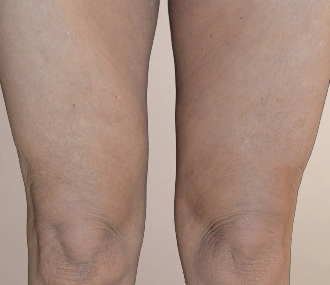 Ezen a képen egy Dr.Bor Mihály plasztikai sebész általi ajaktöltés utáni állapot látható.